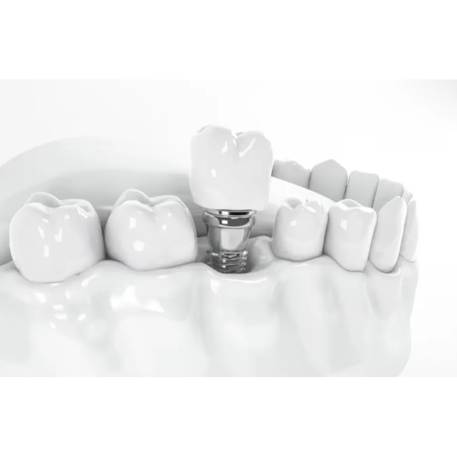 Quality Dental Implants in Narayangaon Junnar Rd I...