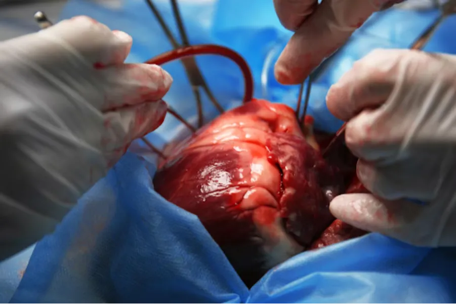 OPCAB Surgery in Nagpur Off-Pump Coronary Artery B...