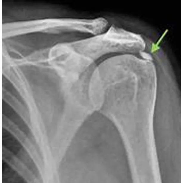 Calcification of the Supraspinatus Tendon: Cause o...