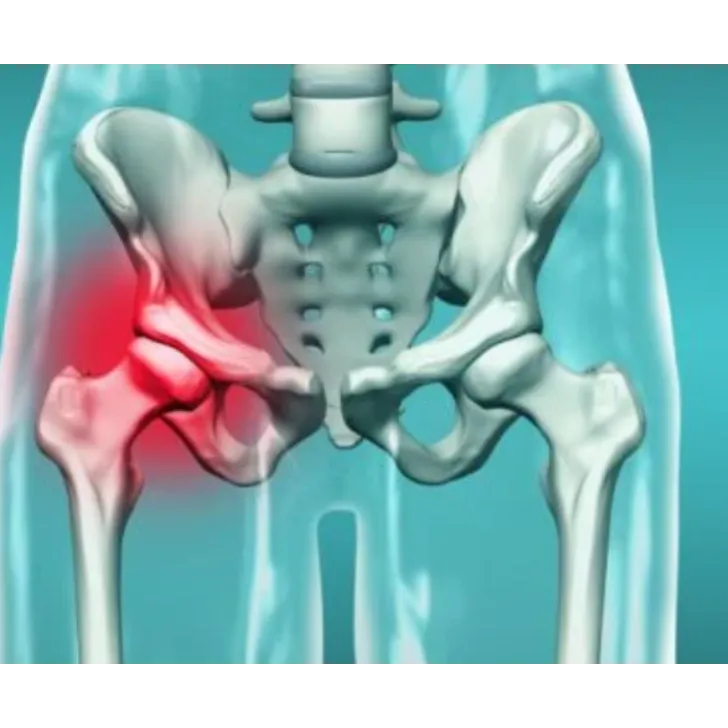 AVN Treatment in Nagpur – Get Expert Care for Avas...