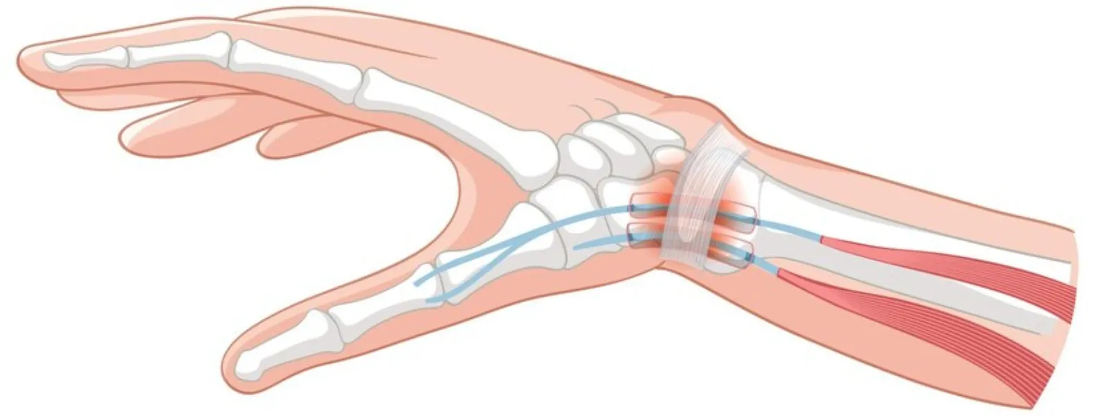 Carpal Tunnel Decompression in New Tippasandra, Be...
