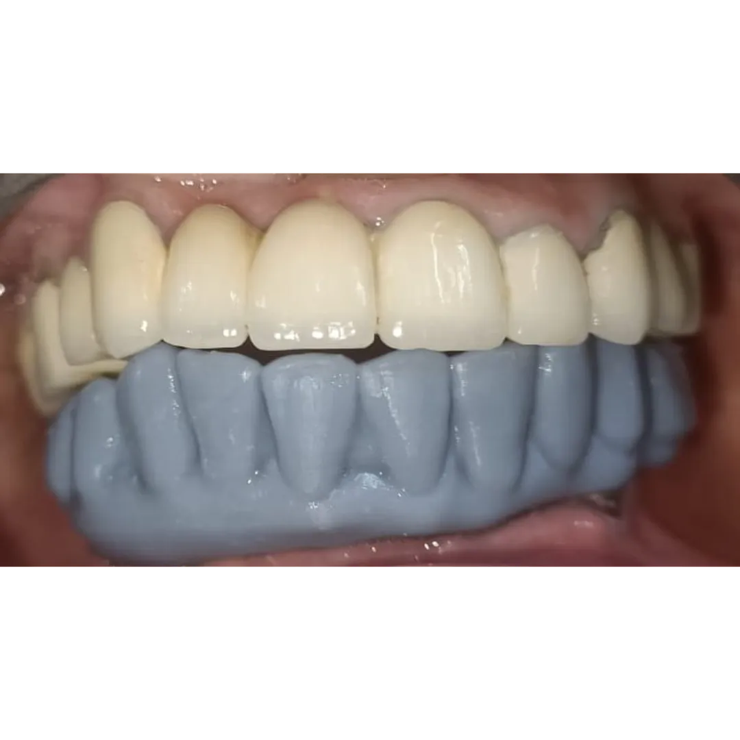 🦷 Smile Design in Progress!
What you’re seeing he...
