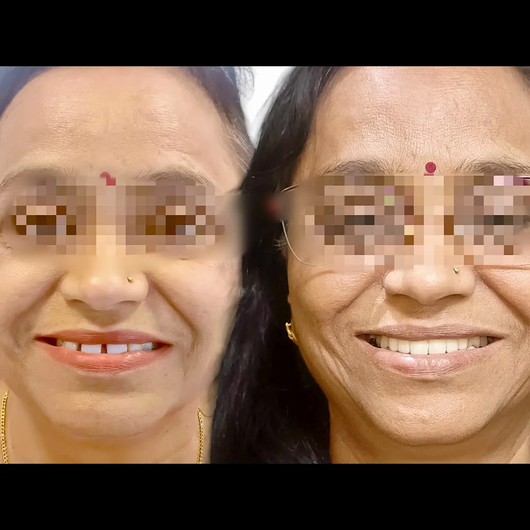 ✨ Zirconia Bridge Smile Transformation! ✨
At Proca...