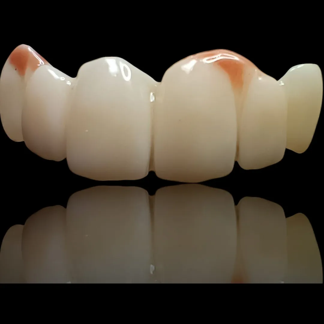 🦷 Crafted to Perfection – Zirconia Bridge 🦷
A clos...