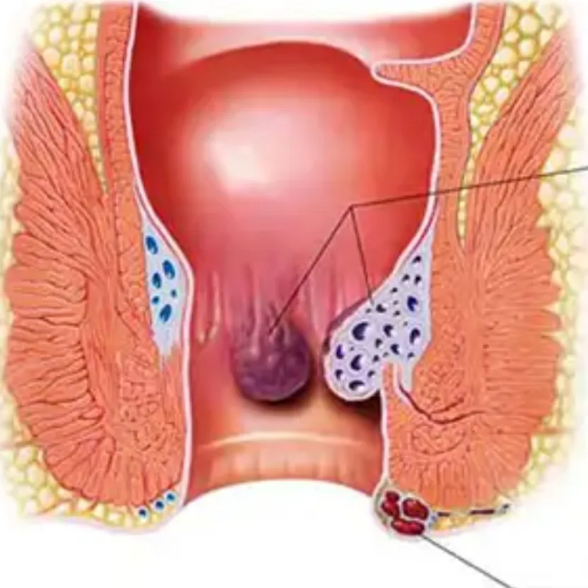 Piles Laser Surgeon in Mumbai – Fast, Painless Rec...