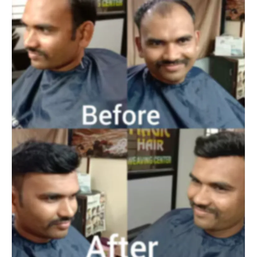 Natural Hair Patches Center in Nagpur – Undetectab...