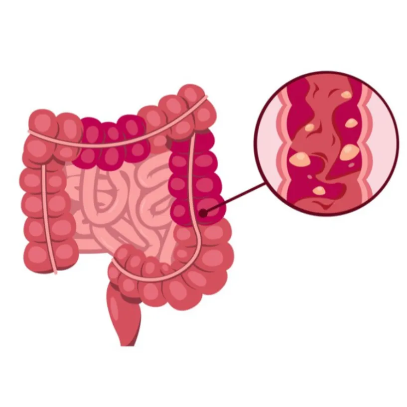Managing Ulcerative Colitis with Expert Care in Mu...