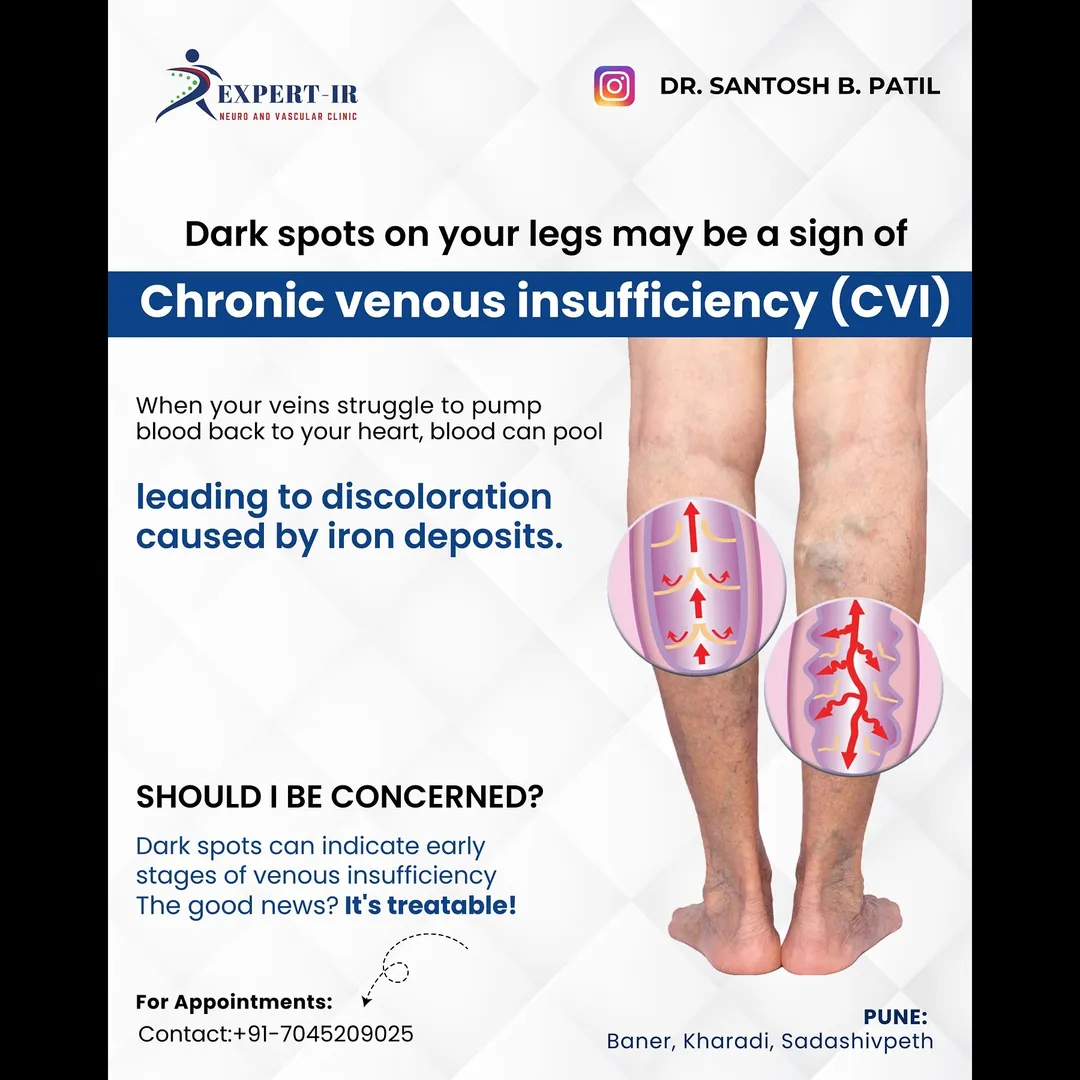 🦵Dark spots on your legs may be a subtle sign of a...