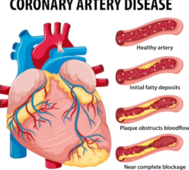 Coronary Artery Disease Treatment in Chennai Coron...