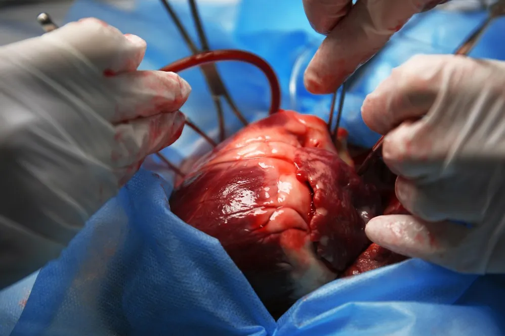 Valve Surgery in Nagpur Valve Surgery involves rep...
