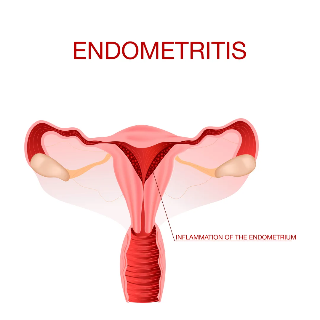 Endometriosis in Thane – Long-Term Relief with Spe...