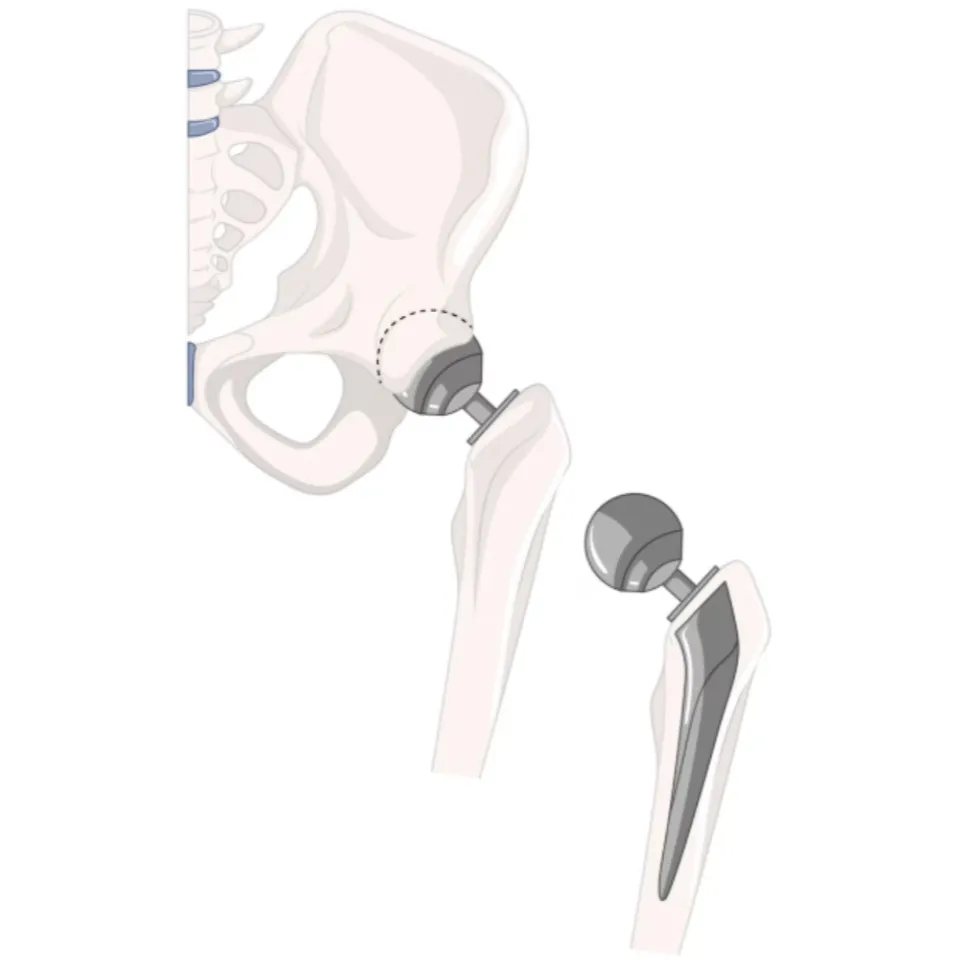 Robotic Hip Replacement in North Bangalore – Moder...
