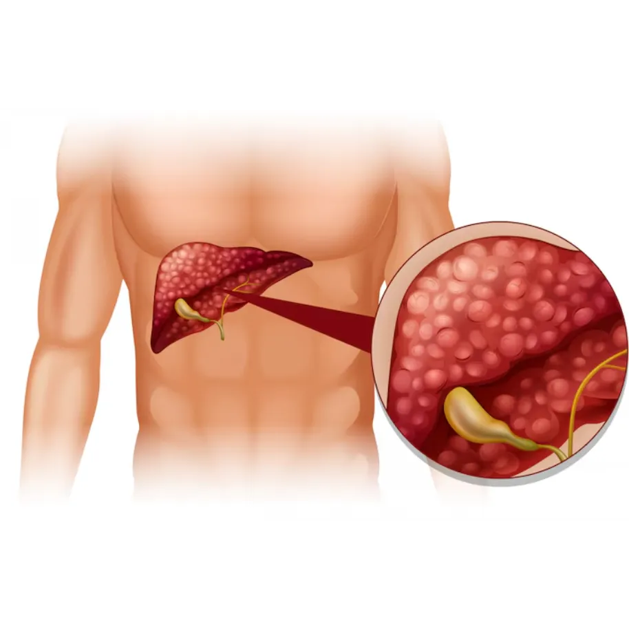 Fatty Liver Doctor in Mumbai – Tailored Approach t...