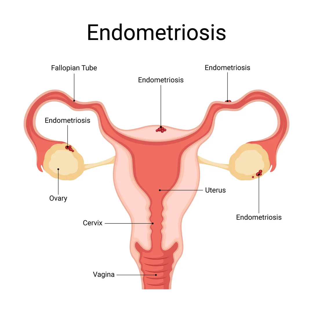 Endometriosis Specialist in Mumbai – Relief from P...