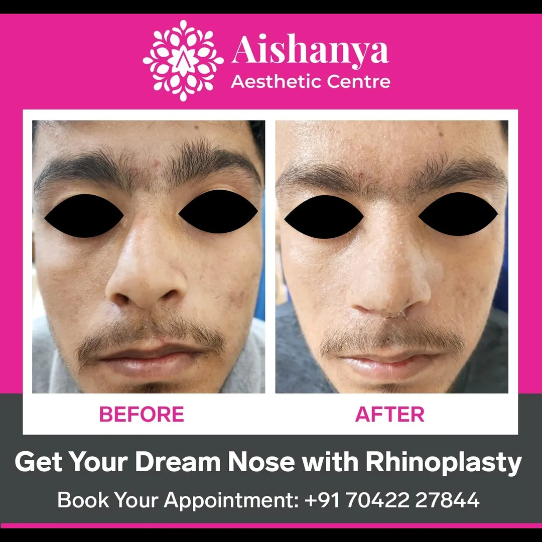 Nose Job in Dwarka
A nose job, also known as rhin...