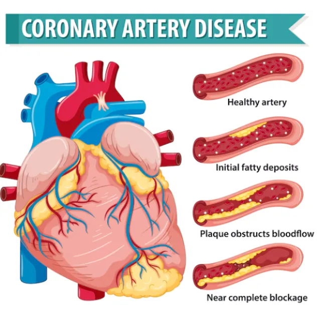 Symptoms of Coronary Artery Disease in Tamil Nadu ...