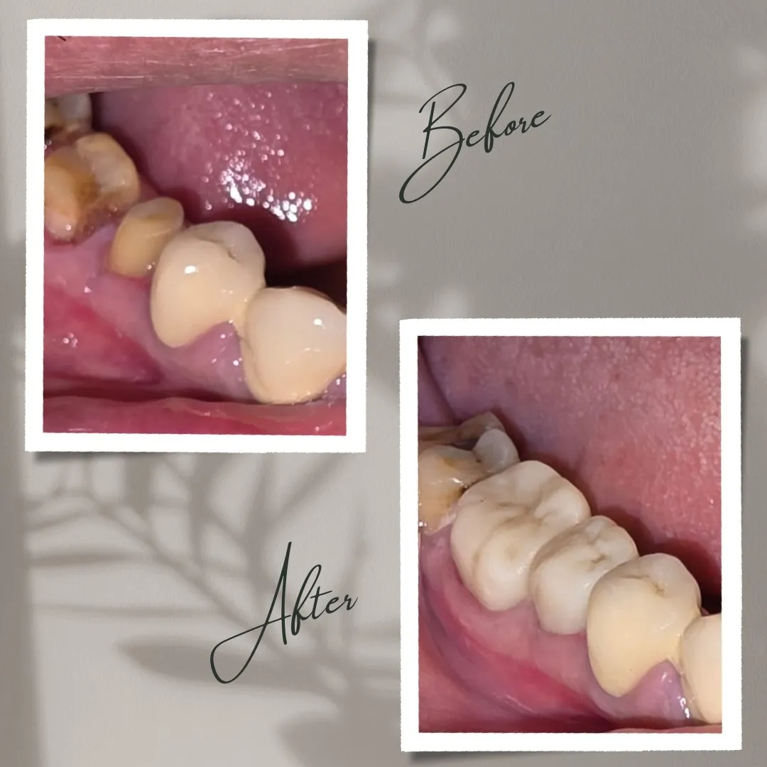 ✨ Transforming Smiles, Restoring Confidence ✨
Swip...