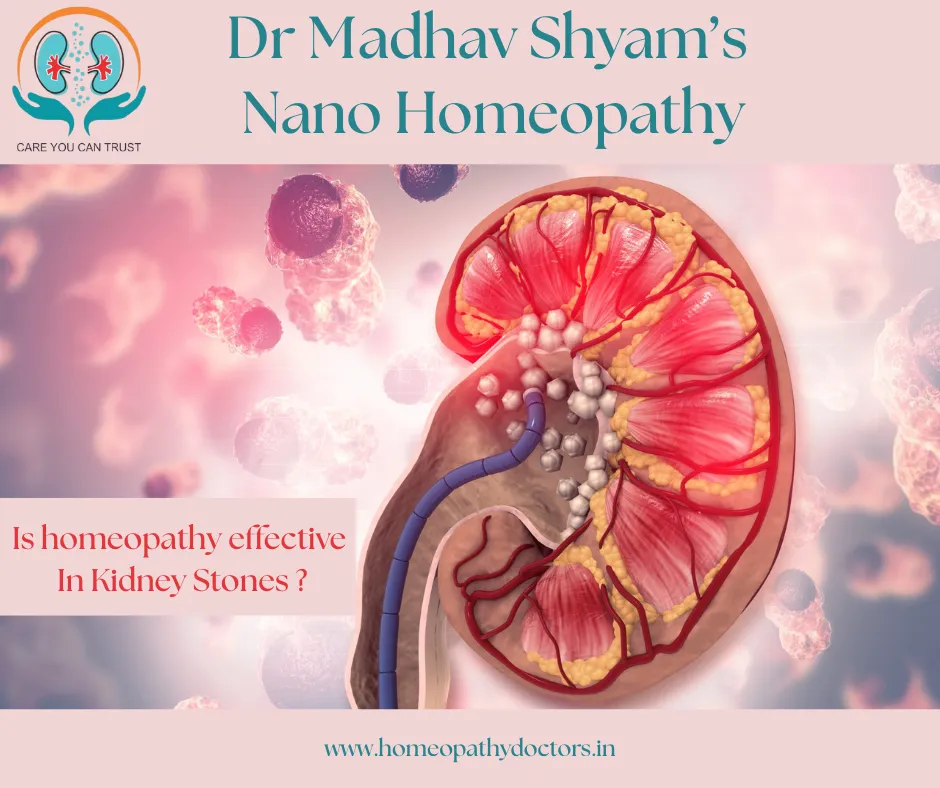 Kidney stones are hard deposits made of minerals a...