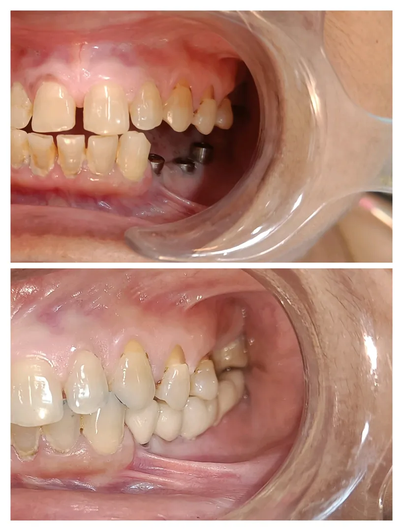 Conventional Dental Implants By Dr. Navratna Singh...