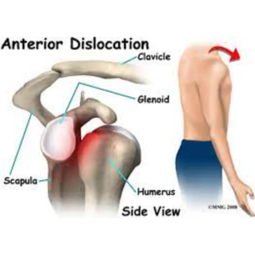 Shoulder Dislocation and Instability Treatment in ...