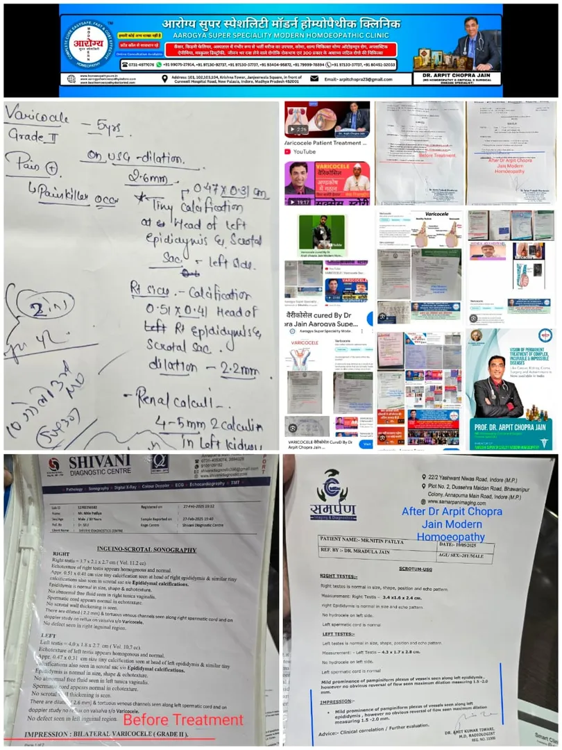 Varicocele वैरिकोसिल स्टेज 4 तक डॉ अर्पित चोपड़ा ज...