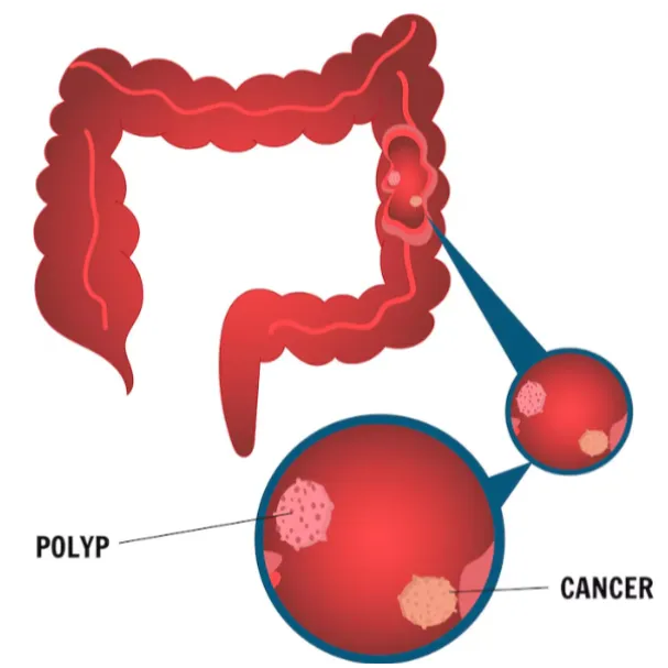 Identifying Colonic Polyps Before They Turn Cancer...