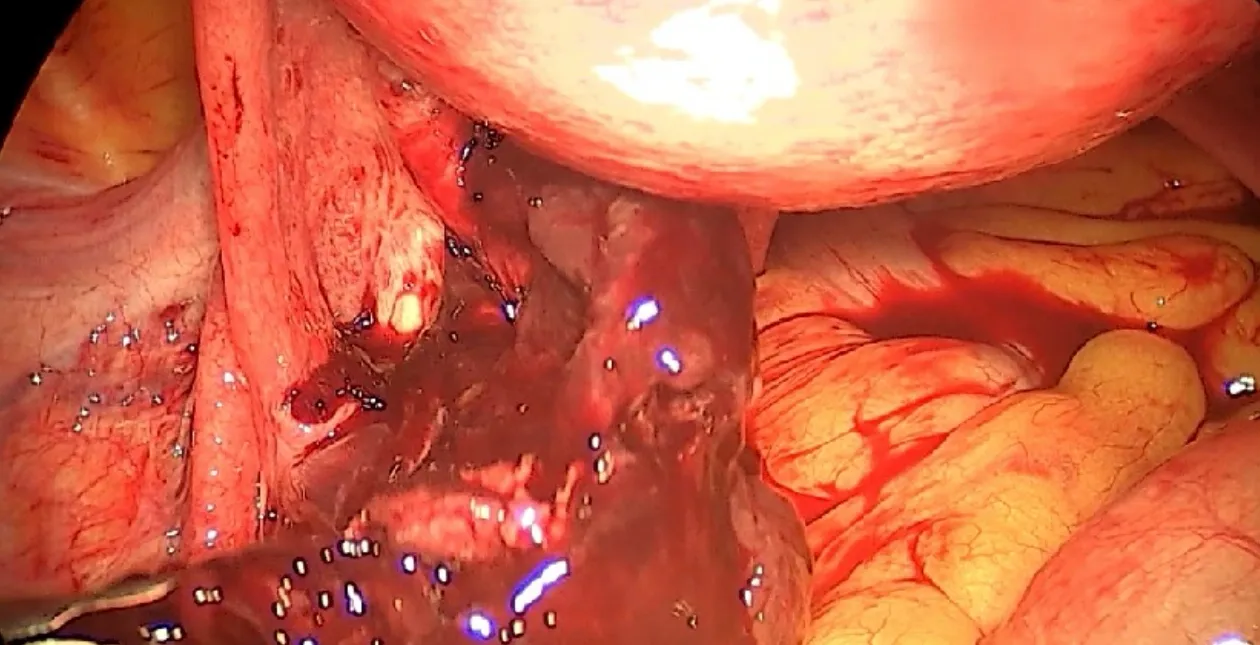 #SaveLiveswithLaparoscopy
An early morning patien...