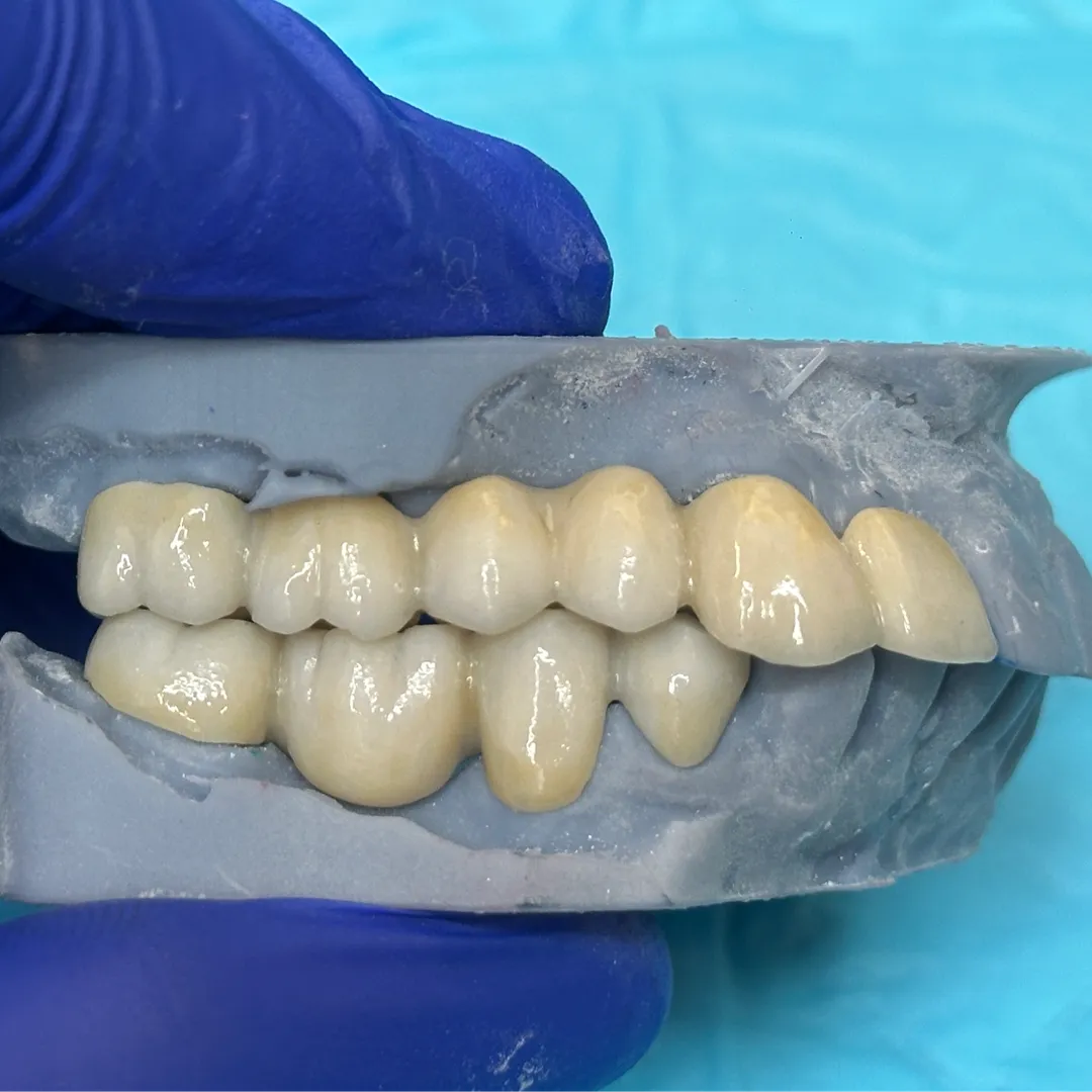 Full Mouth Rehabilitation with Zirconia Crowns – P...