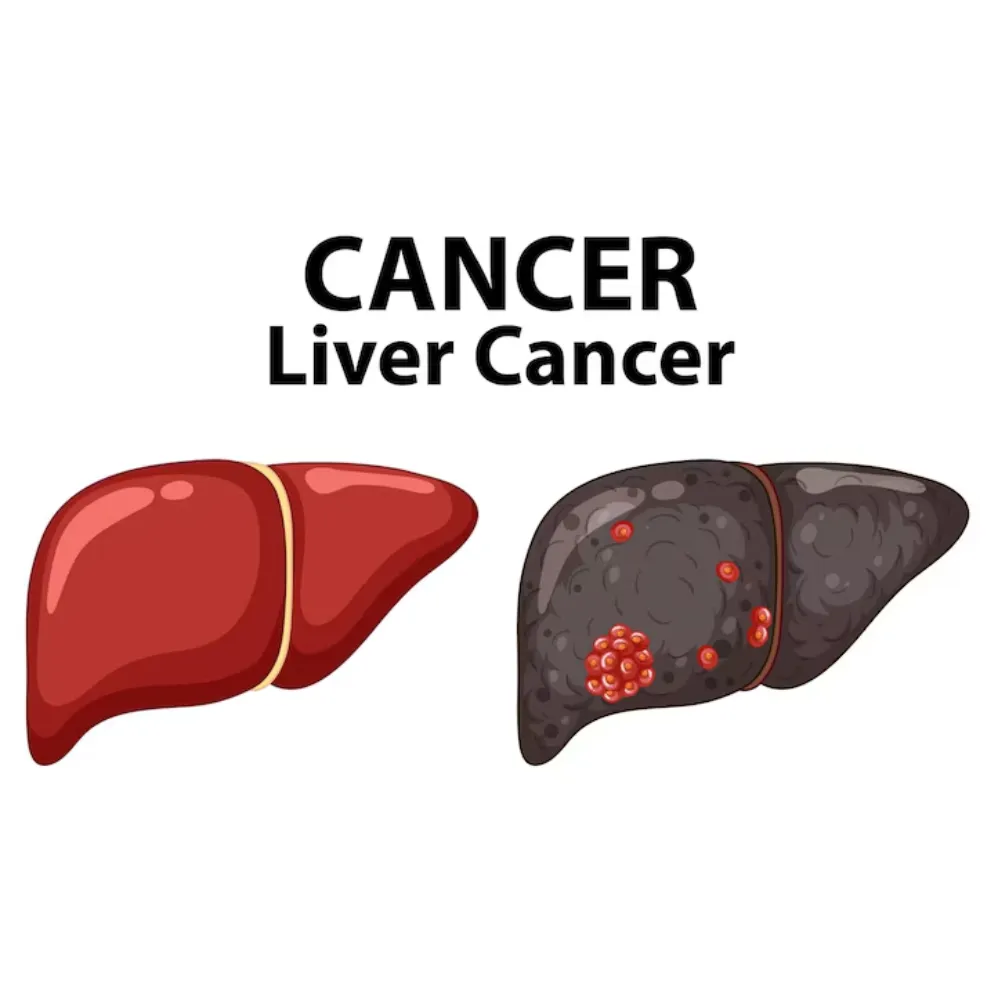 Liver Cancer Specialist in Mumbai – Expert Guidanc...