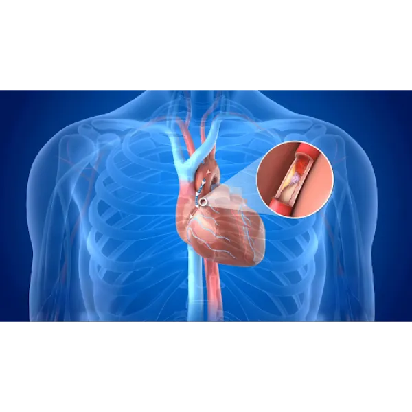 Coronary Bypass Surgery in Pune – Trusted Cardiac ...