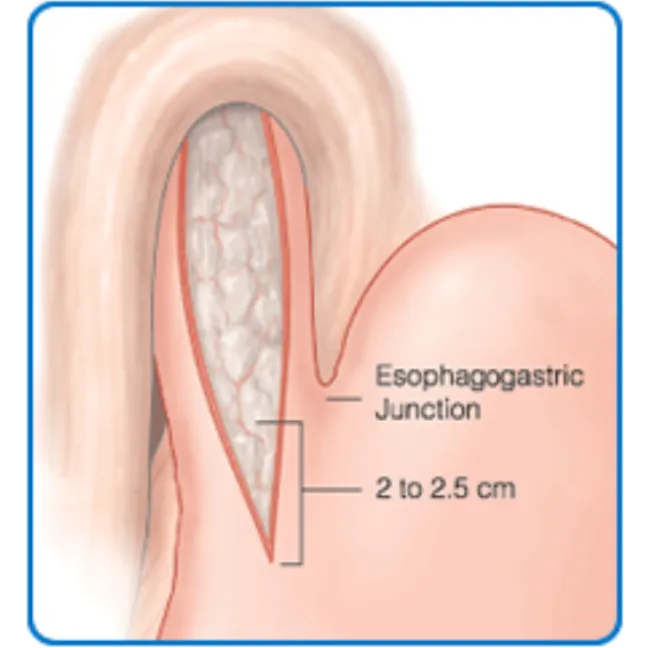 Cardiomyotomy Surgery in Nagpur: Relief for Achala...