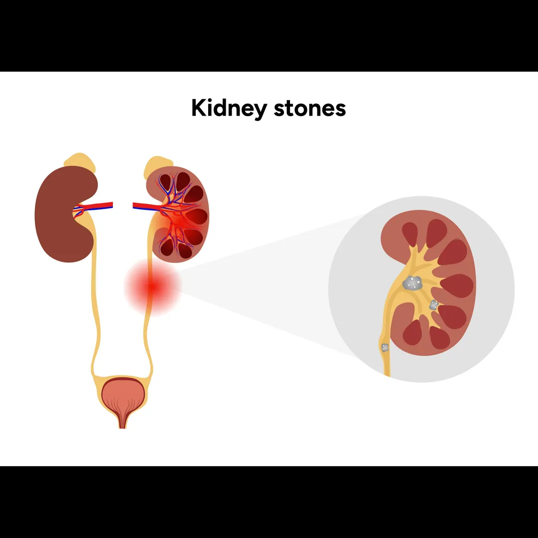 Experienced Urologist For Kidney Stone in Runwal N...