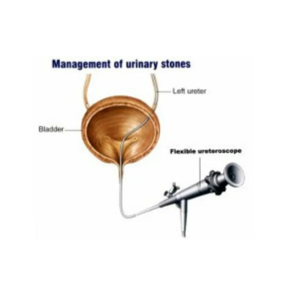 Laser Kidney Stone Removal Specialists in Kopri Co...