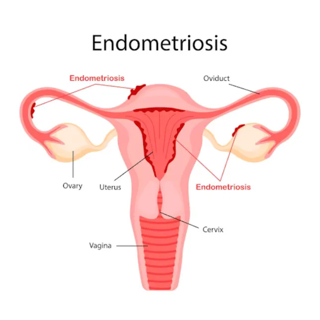 Endometriosis Treatment in Thane – Relief from Chr...