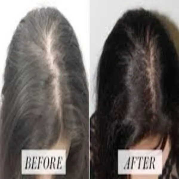 PRP Therapy for Hair Loss In Dhule | Natural Hair ...