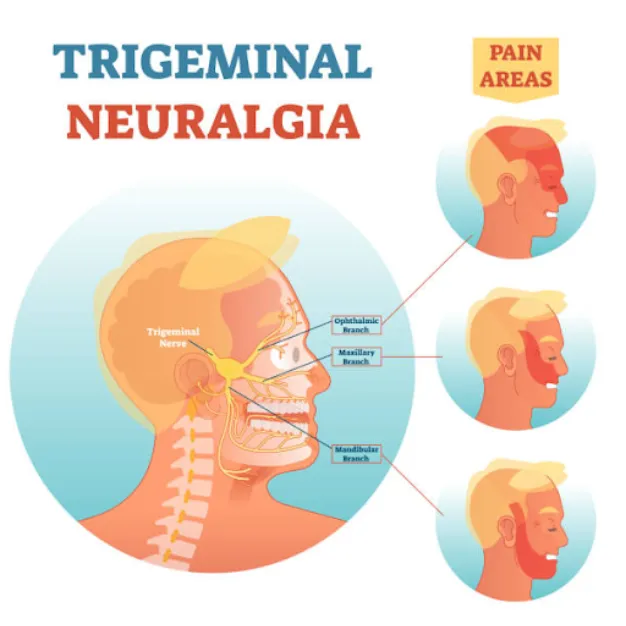 Trigeminal Neuralgia – Facial Pain Treatment In Na...