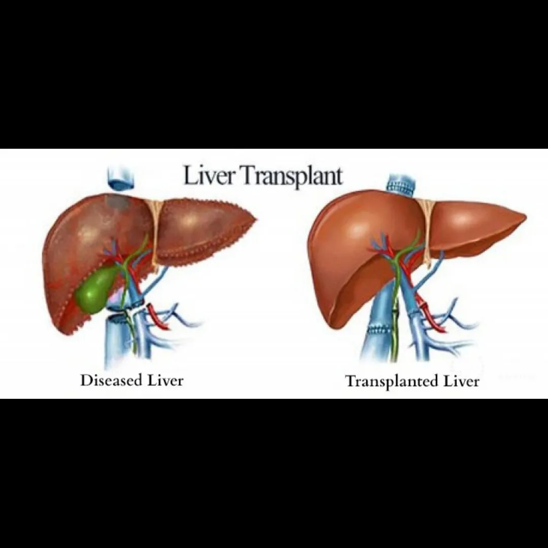 Liver Transplant Service Update | Dr. Chetan Kalal...