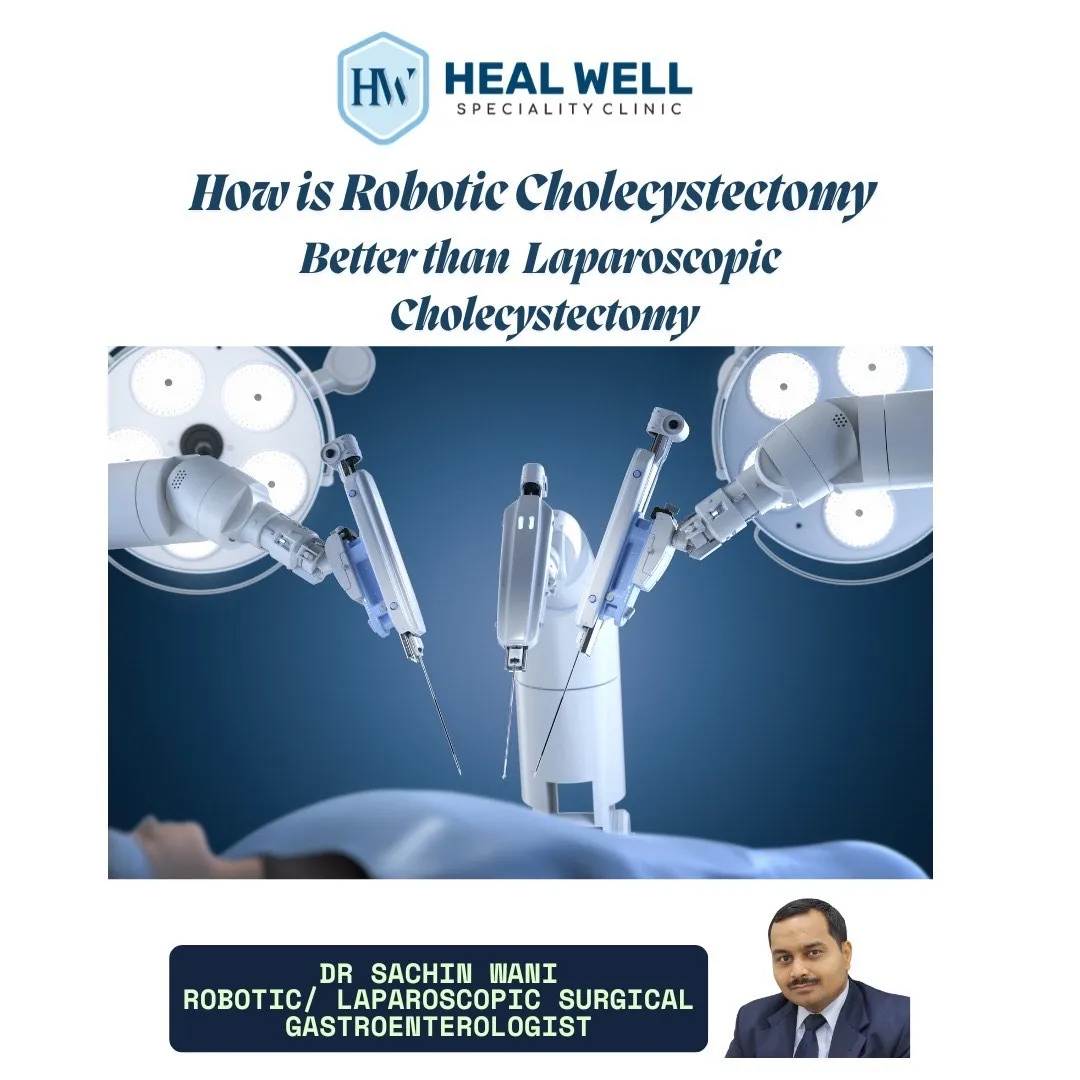 Robotic Cholecystectomy Surgery in Thane – Safer G...