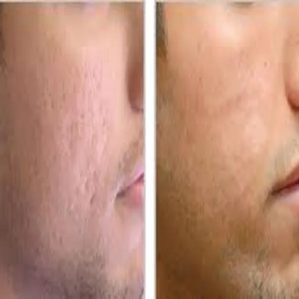 Acne Scar Treatment in Nandurbar - Get Clear, Smoo...