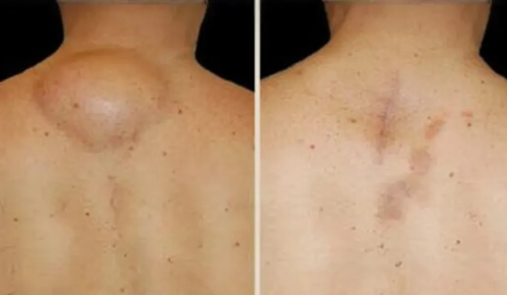Lipoma Removal Surgery Treatment in Kolathur, Chen...