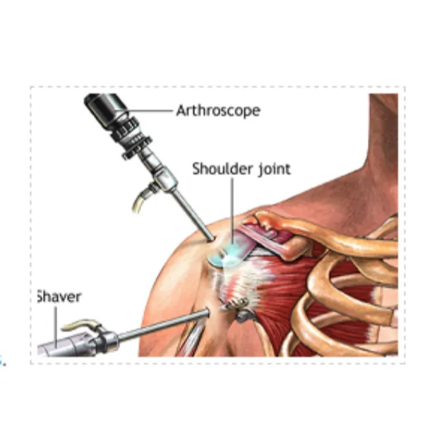 SLAP Repair in Bangalore – Advanced Solution for S...
