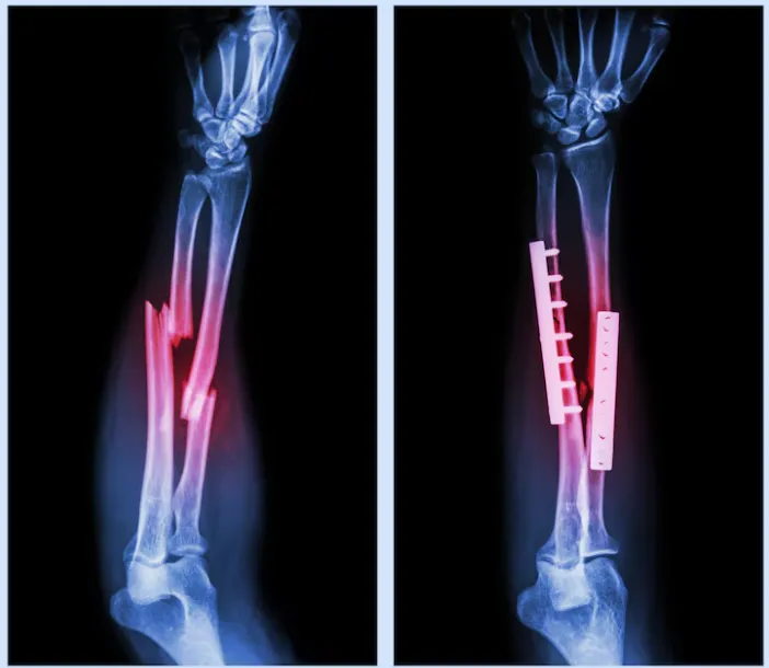 Fracture Fixation in Hennur – Rapid, Reliable Orth...