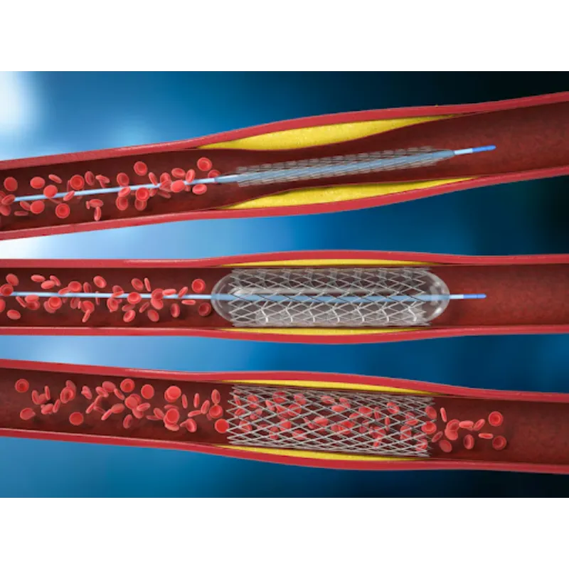 Angioplasty Treatment in Pune – Immediate Relief f...