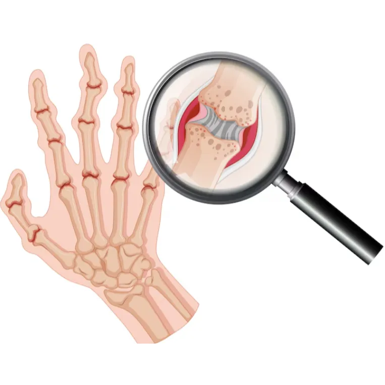 Osteoporosis – Strengthening Bone Health in Noida ...
