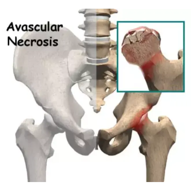Avascular Necrosis in Nagpur – Advanced Treatment ...