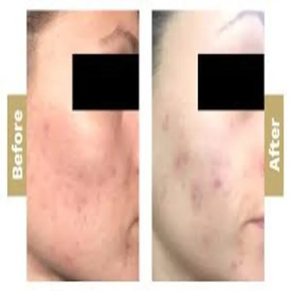 Chemical Peeling for Acne in Dhule | Clearer Skin ...
