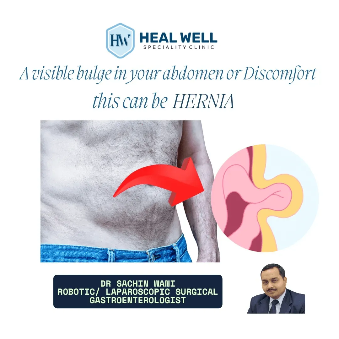 Hernia Surgery in Thane – Reliable Solutions from ...