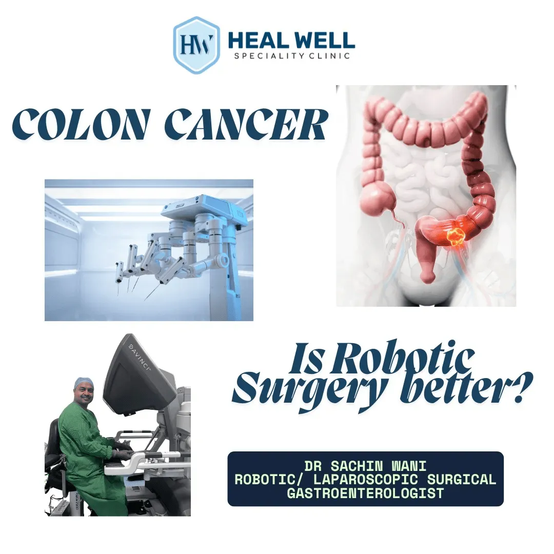 Robotic Surgery for Colon Cancer in Thane – Advanc...