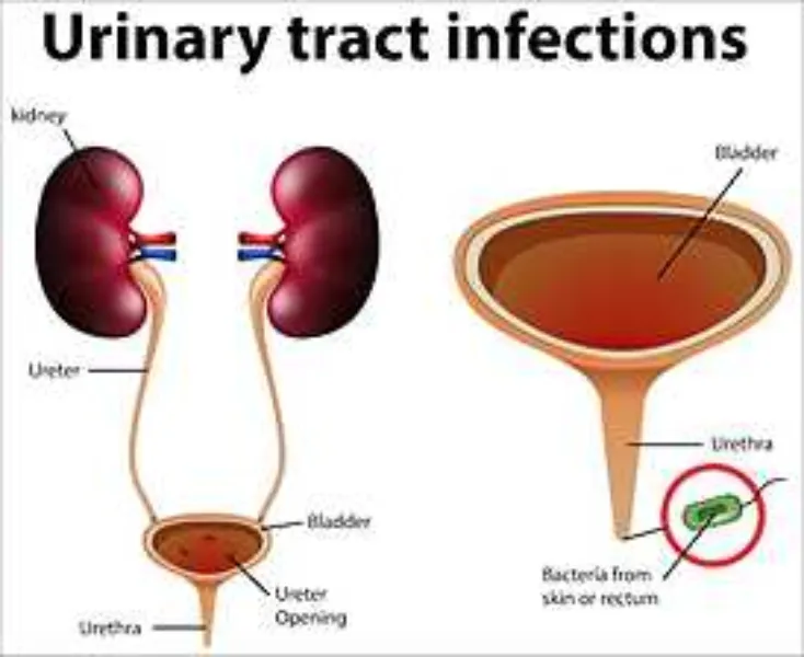 Best Clinic For Urine Infection Treatment in Chara...