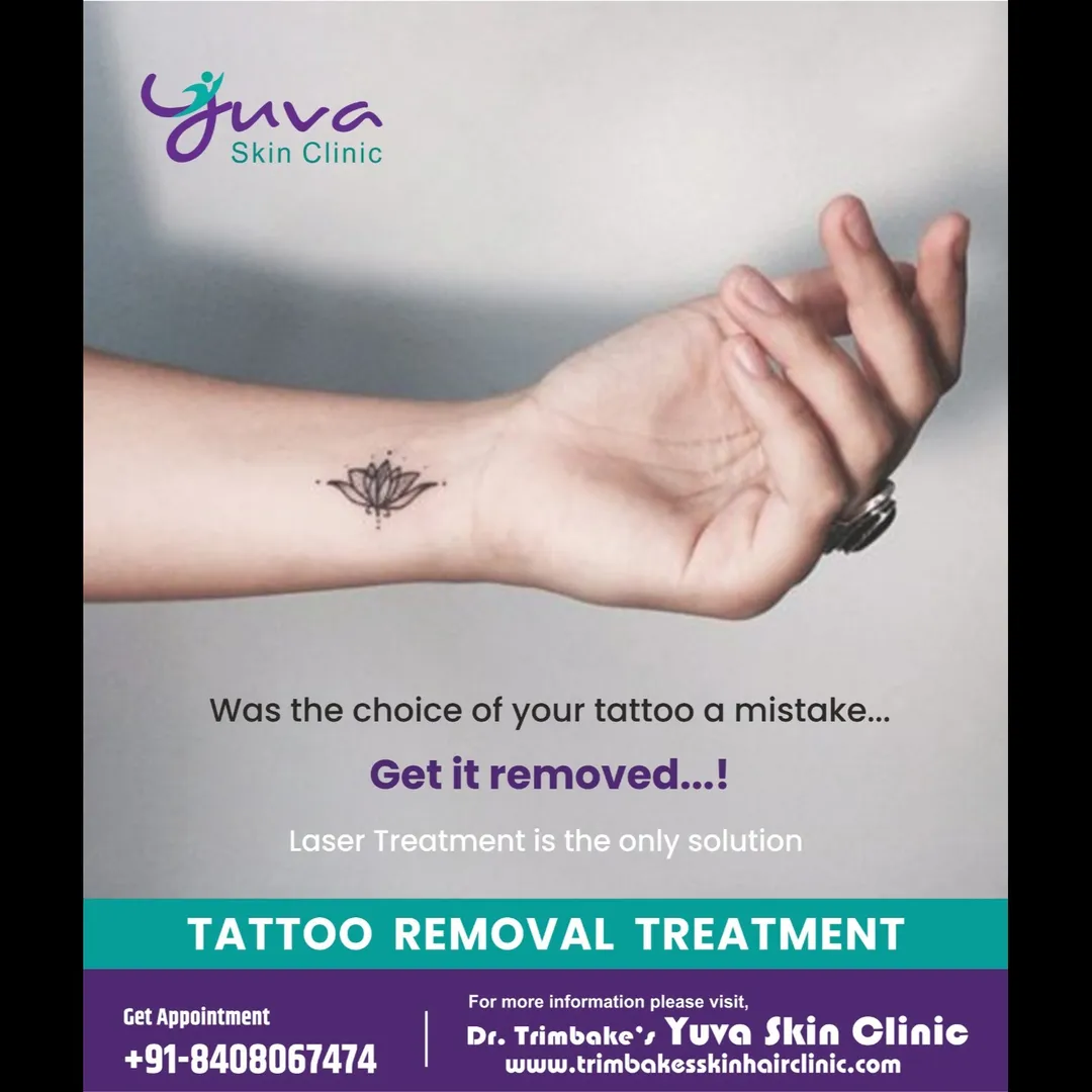 Tattoo Removal Treatment
Getting bored of your per...